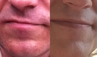 Anna’s chin (left) after laser treatment in May 2017, (right) in December 2017